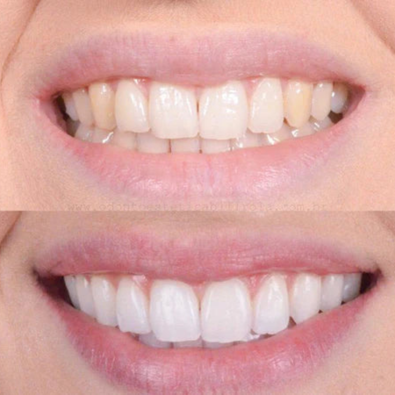 Snelle tandbleking voor een stralende glimlach
