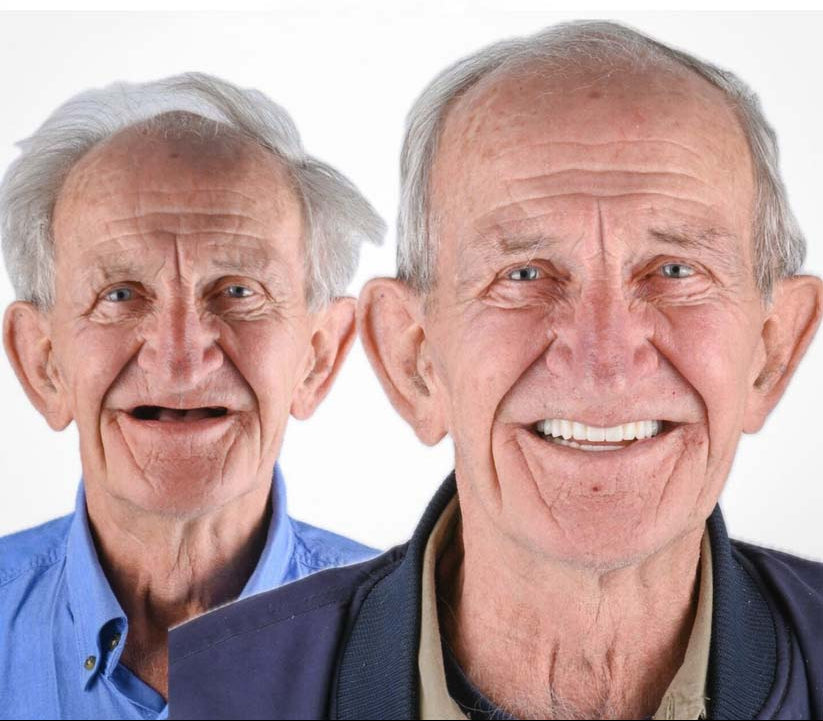 DentalKit - Natuurlijke Look en Gevoel Zonder de Tandarts!