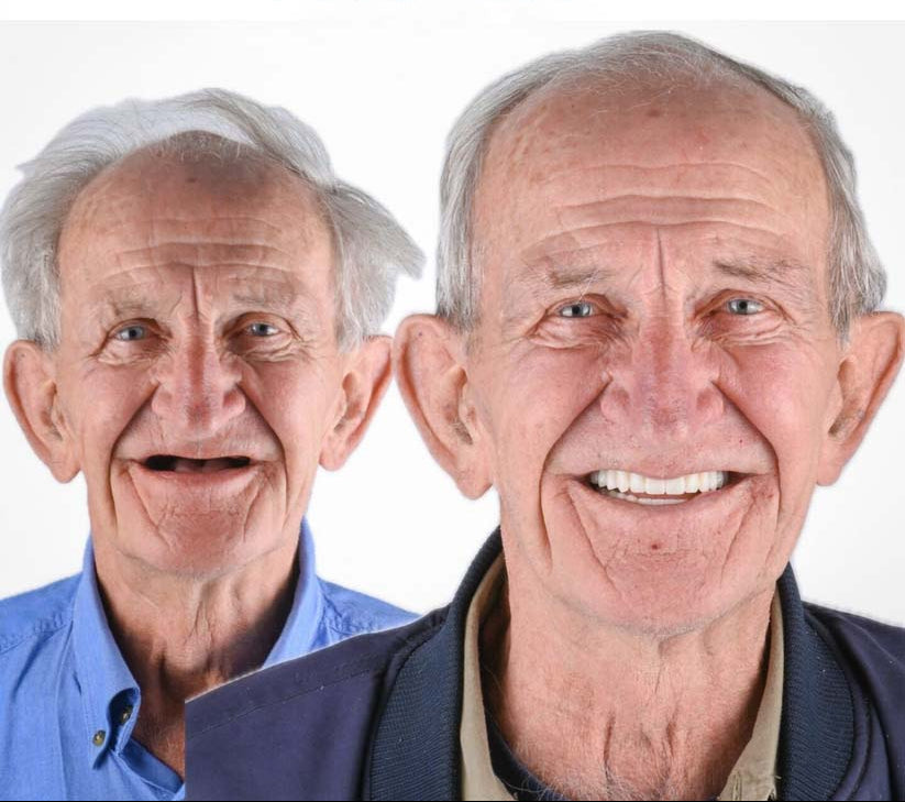 DentalKit - Natuurlijke uitstraling en gevoel zonder de tandarts!