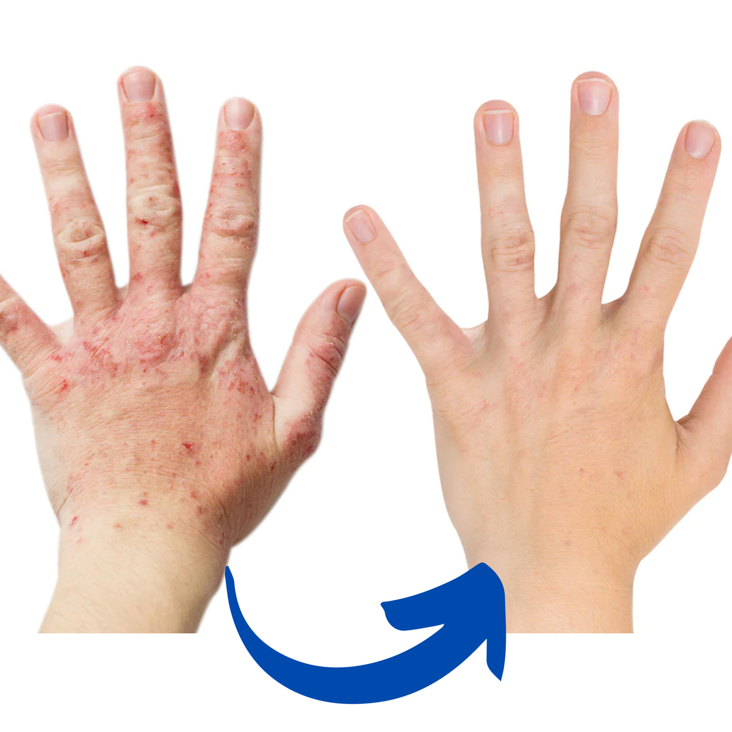 ArthroGlow Near Infrared Handtherapie Handschoenen Voor Artritis Pijnverlichting