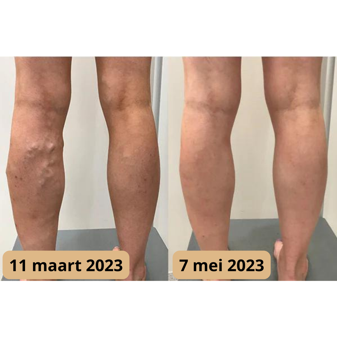 Lymfomat | Acupunctuurpunten-therapie voor een betere doorbloeding