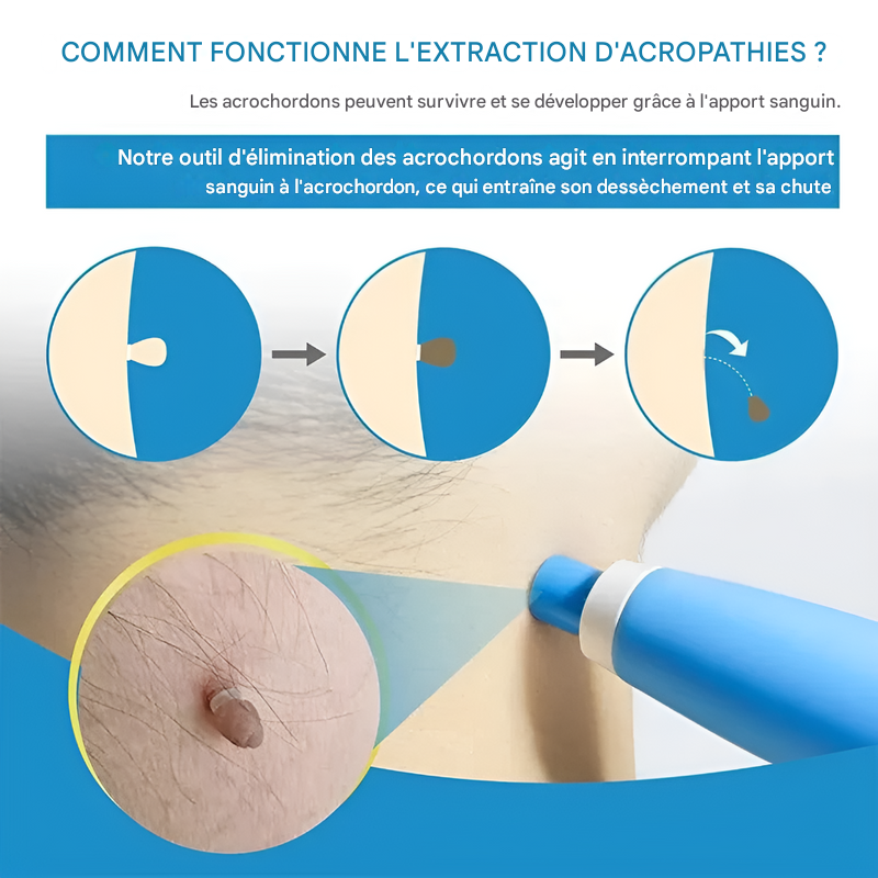 Verwijderingskit voor Acrochordons - Eenvoudige Cryotherapie