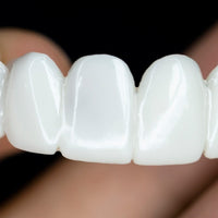 Verwijderbare Tandveneer met Natuurlijke Uiterlijk voor een Esthetische Glimlach