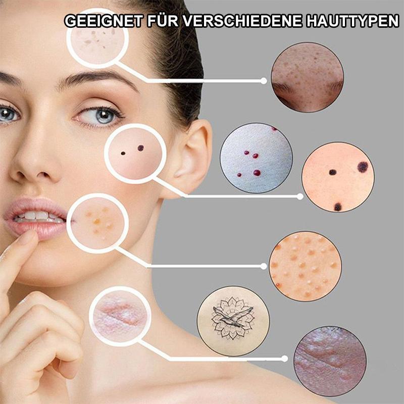 Laserbehandeling-Stift Blu-Ray ongewenste acne verwijderen