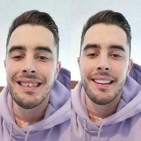 Op Smile Veneers (boven- en onderkaak inbegrepen)