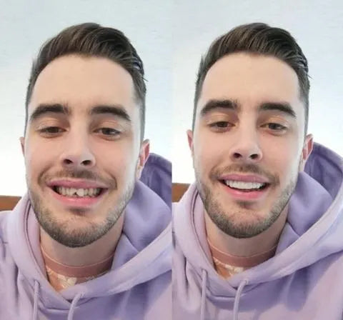 Op Smile Veneers (boven- en onderkaak inbegrepen)