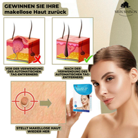 Skanto | DermaLinx Wratverwijderaar | Pijnloze verwijdering van wratten en moedervlekken | Voor thuis | Zonder chirurgie