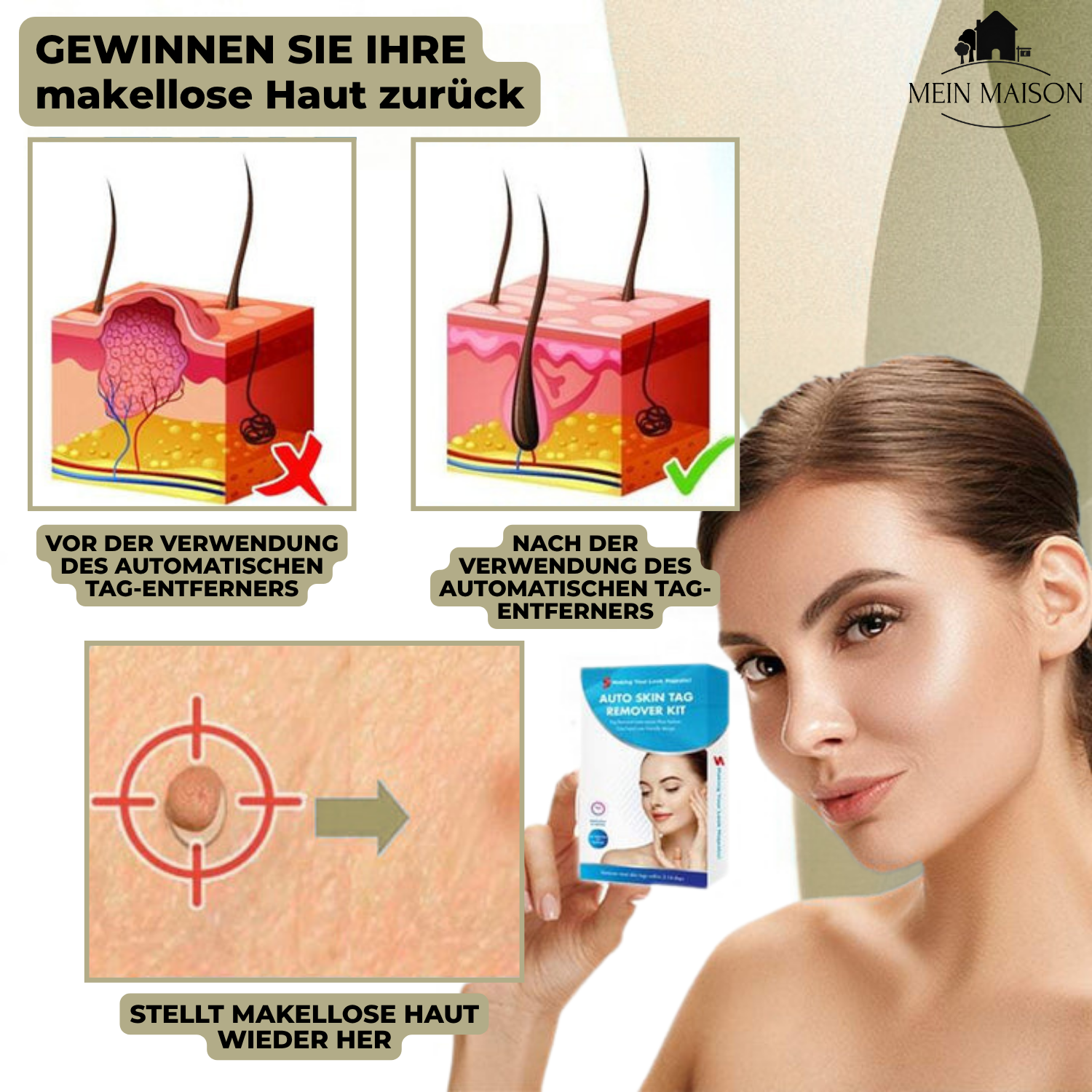 Skanto | DermaLinx Wratverwijderaar | Pijnloze verwijdering van wratten en moedervlekken | Voor thuis | Zonder chirurgie