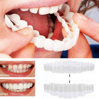 Op Smile Veneers (boven- en onderkaak inbegrepen)
