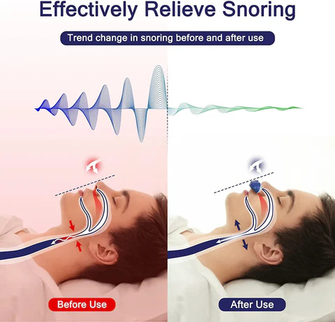 Micro CPAP Slaapapneu-apparaat voor Reizen & Anti-Snurken - CPAP-Alternatief