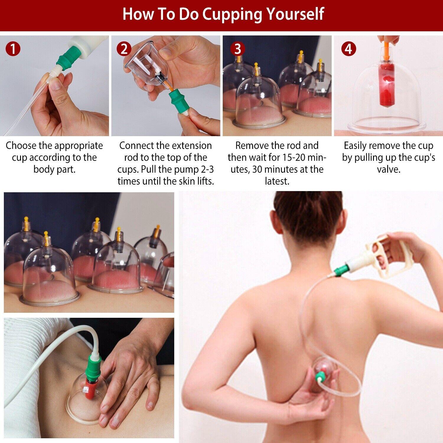 CuppingThera Pro | Set van 32 Stuk Therapie met Cups voor Massage en Acupunctuur