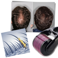 LuxaSkin | Collageenversterkende microneedling voor een jeugdige uitstraling
