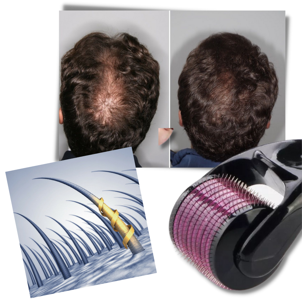 LuxaSkin | Collageenversterkende microneedling voor een jeugdige uitstraling