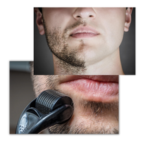 LuxaSkin | Collageenversterkende microneedling voor een jeugdige uitstraling