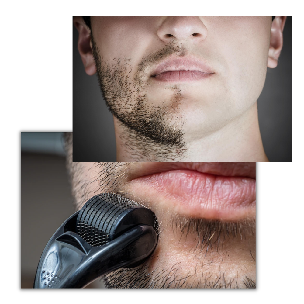 LuxaSkin | Collageenversterkende microneedling voor een jeugdige uitstraling