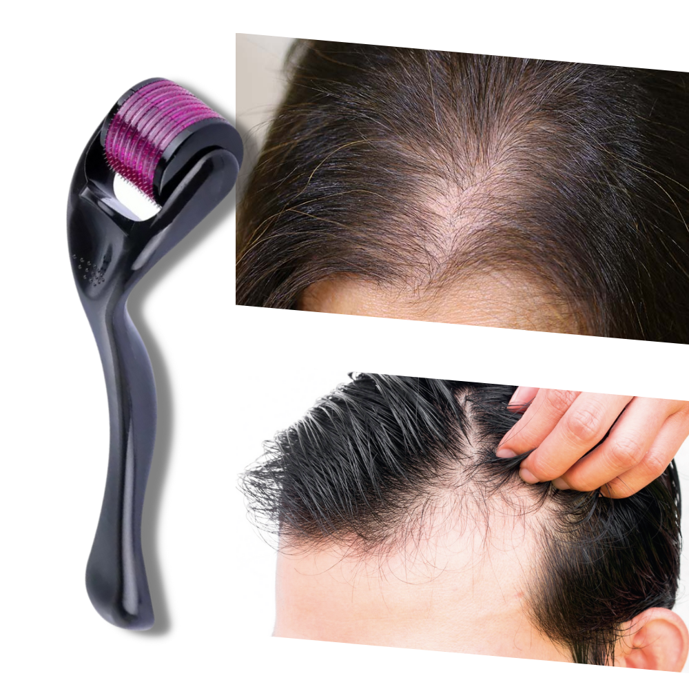 LuxaSkin | Collageenversterkende microneedling voor een jeugdige uitstraling