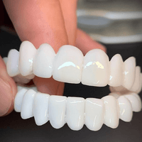 DenturaFlex | Aanpasbare Tandprothese met Natuurlijke Uiterlijk voor Comfort