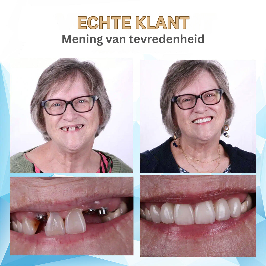 Bikenda | Ervaar het comfort van een kunstgebit voor een fractie van de prijs