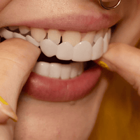 SmileSnap | Directe Veneer Transformatie Kit voor Esthetische Tandbedekking
