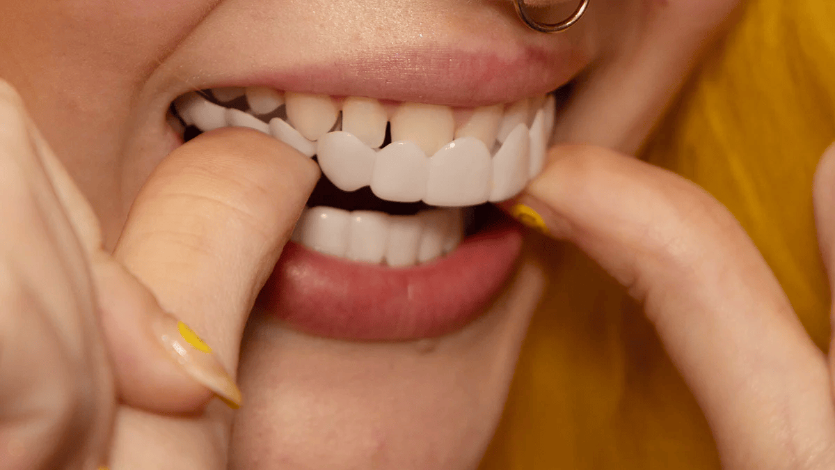 SmileSnap | Directe Veneer Transformatie Kit voor Esthetische Tandbedekking