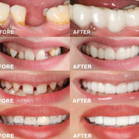 Tandprothese | Directe Glimlach zonder Lijm | Flexibele Pasvorm | SmileSnap