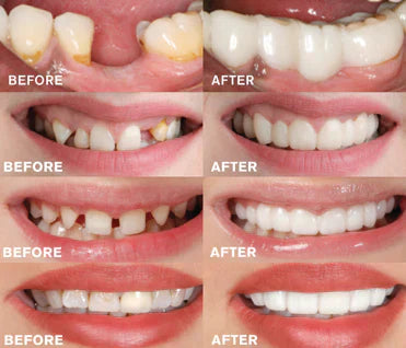 Tandprothese | Directe Glimlach zonder Lijm | Flexibele Pasvorm | SmileSnap