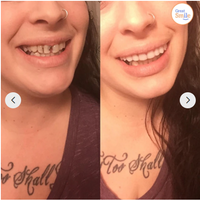 Tandprothese | Directe Glimlach zonder Lijm | Flexibele Pasvorm | SmileSnap