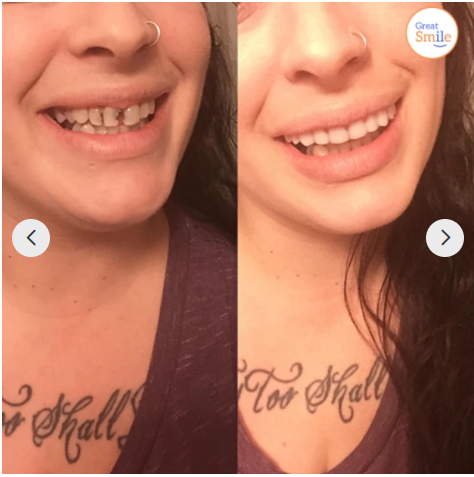Tandprothese | Directe Glimlach zonder Lijm | Flexibele Pasvorm | SmileSnap