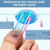 Thuis Laser Behandeling Voor Schimmelnagels NexaLume