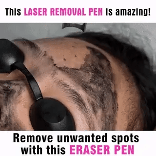 LumiDerm Thuis Laser Pen Voor Het Verwijderen Van Tattoos, Moedervlekken En Vlekken