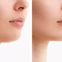 NovaLume ChinContour Roodlichttherapie Band Voor Dubbele Kin