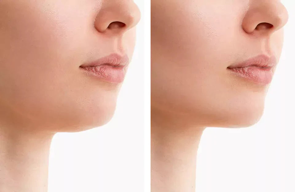 NovaLume ChinContour Roodlichttherapie Band Voor Dubbele Kin