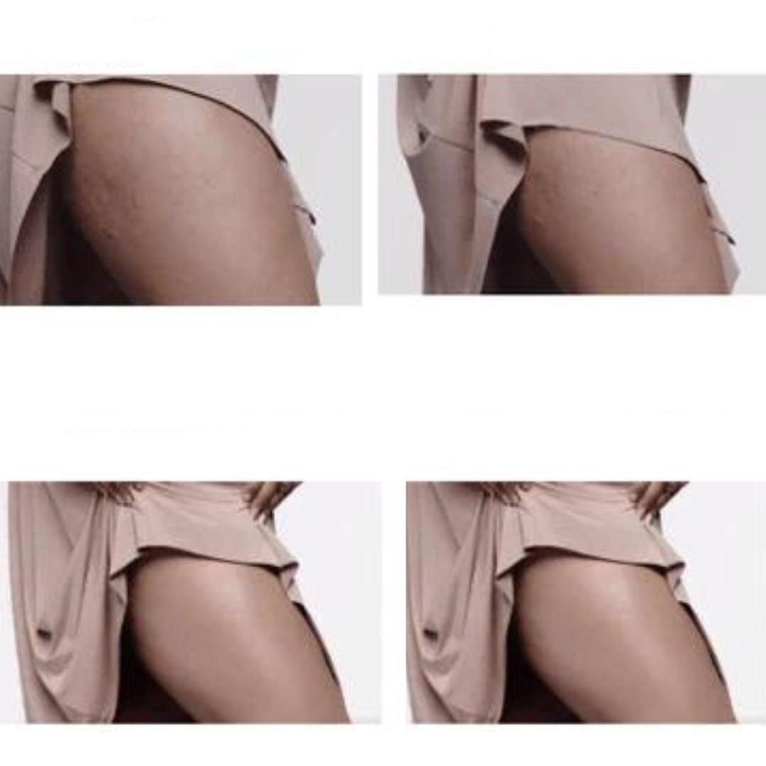 Smooth Tone elektrisch massageapparaa | Bestrijdt cellulitis, verstevigt de huid en verlicht spierspanning