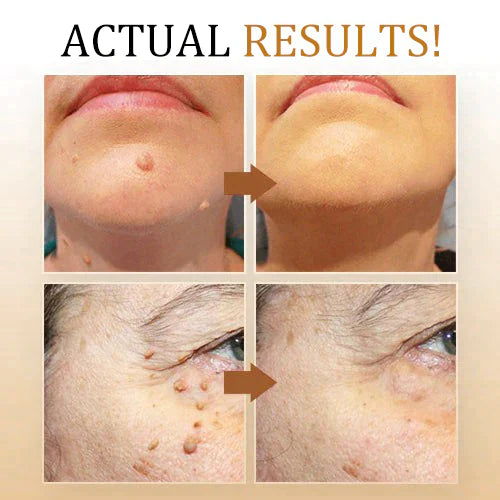 SkinClear | Spray Verwijder Wratten – Zachte en Effectieve Behandeling